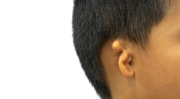 Primo piano di un orecchio di un bambino affetto da microtia.